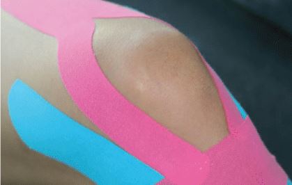 Das Bild zeigt ein Kinesiotape am Kniegelenk. Speziell wird hierbei die Patella (Kniescheibe) gestützt und stabilisiert.